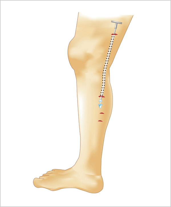 血管外科 社会医療法人一成会 木村病院